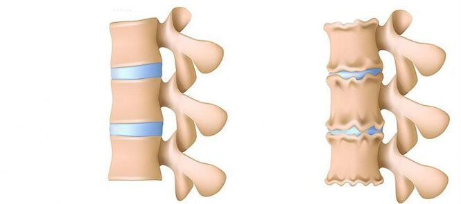 Osteochondrose of the lumbar region