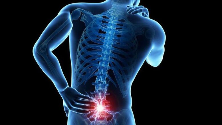 Symptoms of lumbar osteochondrose